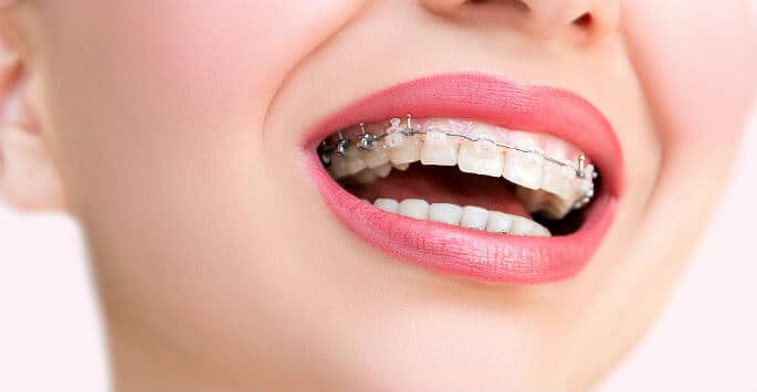 Qu'est-ce qu'Invisalign ? - LRA