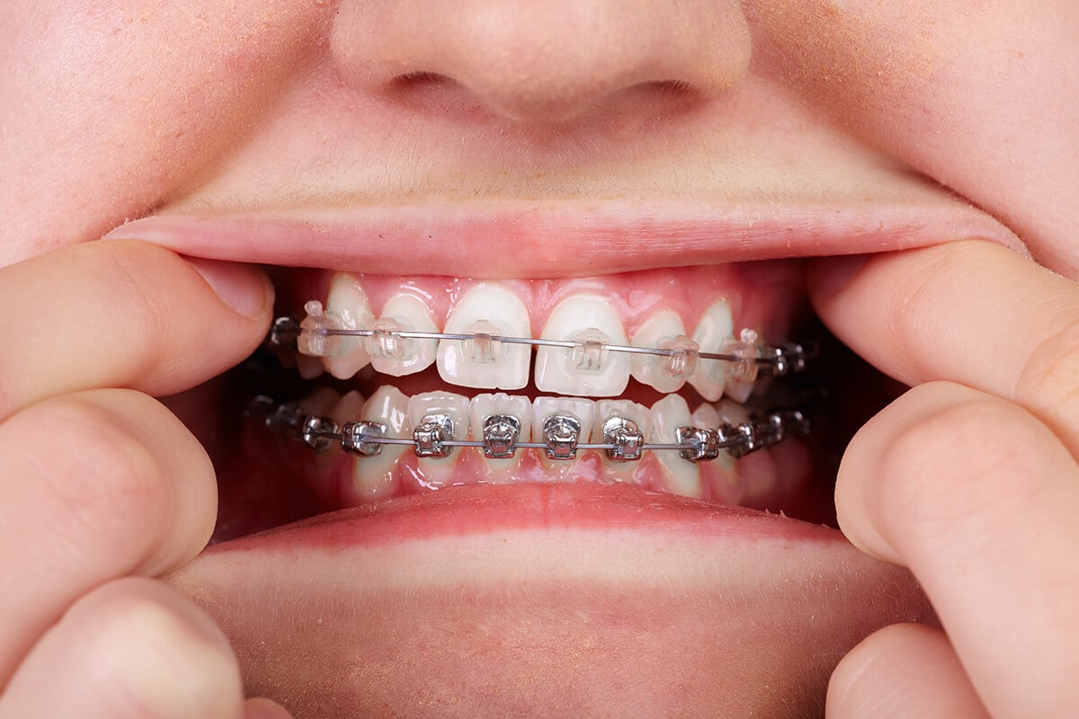 Teeth With Orthodontic Brackets M Scott Runnels Dmd Pa 