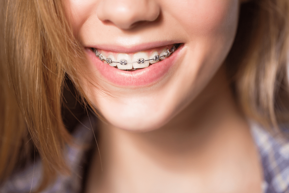 What_Are_the_Benefits_of_Metal_Braces_637902770109963312