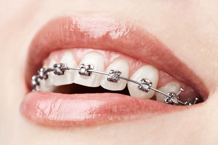 How Long Do People Usually Wear Metal Braces? M. Scott Runnels D.M.D