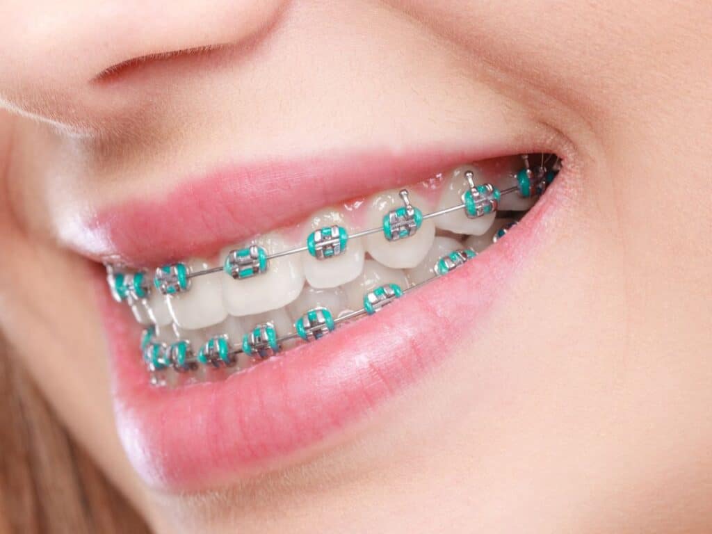What You Can Eat with Your Braces