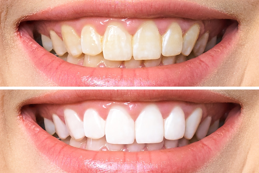 Teeth Whitening in Destin, FL | Runnels Orthodontics