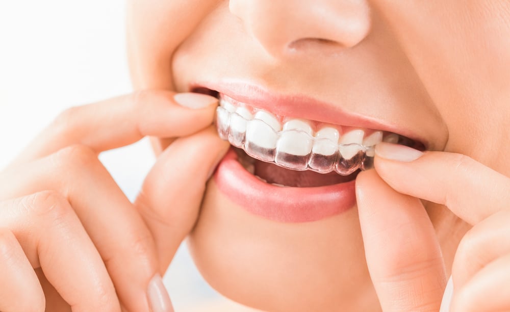Understanding How Invisalign Works | Runnels Orthodontics