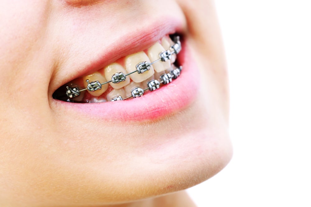 How Long Do Braces Take to Straighten Teeth | Runnels Orthodontics