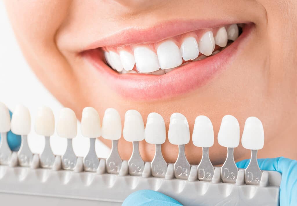 Beautiful,Smile,And,White,Teeth,Of,A,Young,Woman.,Matching